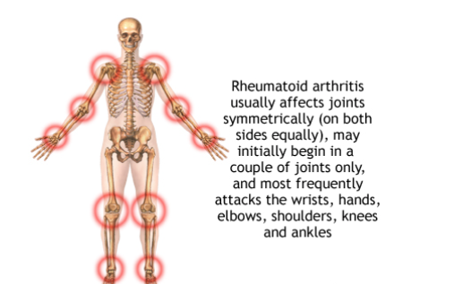 Your smart guide to supplements and arthritis